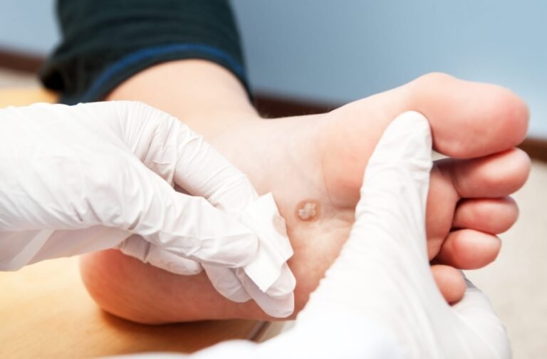 Common Warts: Effective Oil Removal Methods and Symptoms, Diagnosis