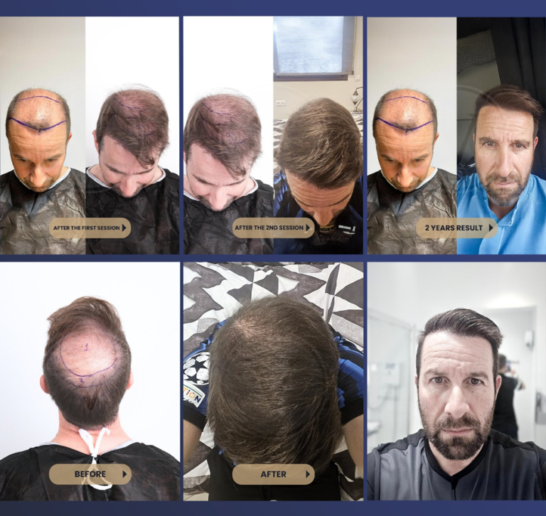 Istanbul Vita Hair Transplant Experience in Turkey