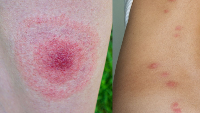 Bites That Aren’t What You Think: Commonly Confused Insect Bites in the UK